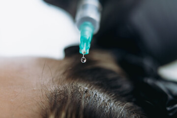 close up on woman head getting mesotherapy injections for stronger and healthier hair