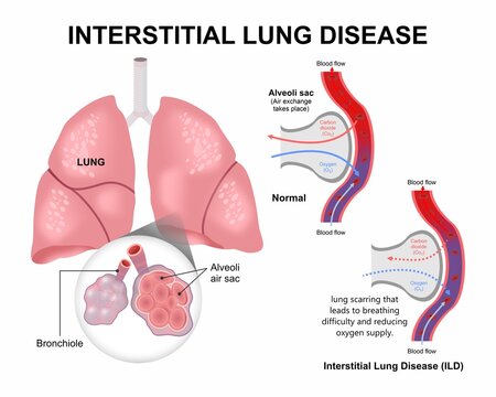 Interstitial Lung Disease medical flashcard illustration