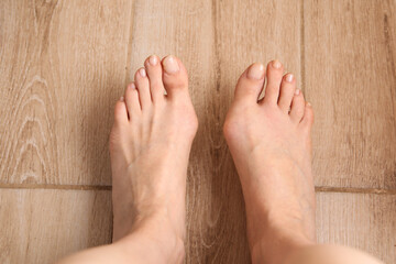 Female feet with hallux valgus, lower limb arthrosis