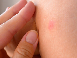 mosquito bites ticks on woman's legs, big red spots on skin, Lyme disease, Chikungunya fever