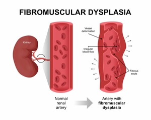 Fibromuscular Dysplasia artery medical flashcard illustration