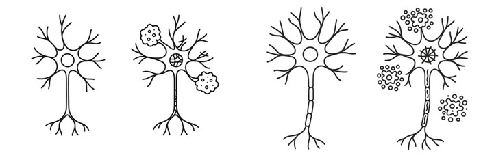 Diagram comparing healthy neurons to diseased neurons with amyloid plaques and demyelination, showing the effects of neurodegenerative conditions
