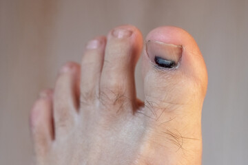 Toe with subungual hematoma after injury, close up of toenail with dark spot, medical illustration...