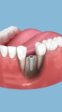 Cover screw and healing cap over implant. Dental 3D animation