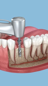 Dental implant and ceramic crown installation. 3D Animation