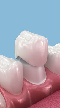 Dental ceramic crown placement. Dental 3D animation
