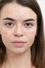 Portrait of young woman with acne on her face, close-up. Acne, skin care concept. Real photo.