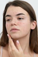 Portrait of young woman with acne on her face, close-up. Acne, skin care concept. Real photo.