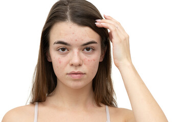 Portrait of young woman with acne on her face. Acne, skin care concept. Real photo.