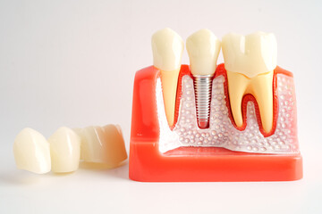 Dental implant, artificial tooth roots into jaw.