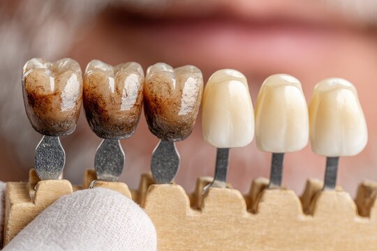 Dental teeth shade guide, showing various shades of discoloration