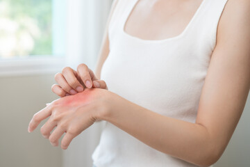 Dermatology asian young woman allergy, allergic reaction from atopic, insect bite, scratching itchy back of hand, red spot or rash of skin. Healthcare treatment of beauty. Isolated on white background