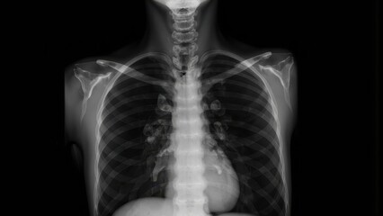 Medical x ray of human chest and upper torso showing skeletal structure and organs