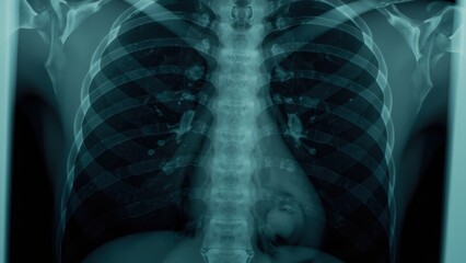 Anterior posterior view of a human chest x ray showing ribs and spine