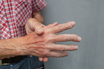 Close-up of an elderly Caucasian man's hands showing signs of rheumatoid arthritis. The hands are swollen and fingers are slightly bent, indicating discomfort.
