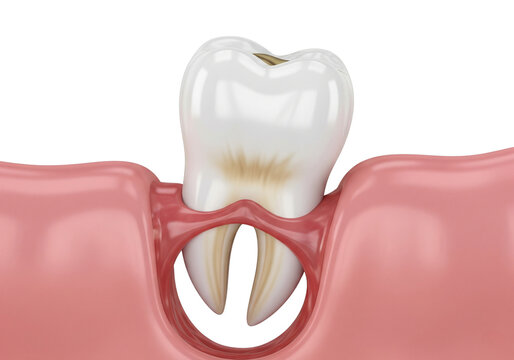 Dental Tooth Extraction: 3D Illustration of a Removed Tooth with Exposed Roots and Alveolar Socket, Highlighting Oral Surgery