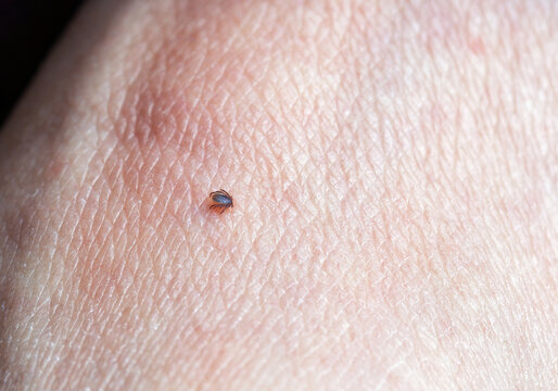 Small Ixodes scapularis insect suck blood.  Little tick insect on human skin