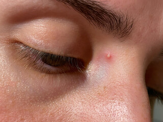 Obraz premium Extreme close-up of a human face with visible pimple near eyebrow. Perfect for educational, dermatology, beauty, or healthcare visuals.