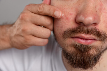 Young man with acne problem applying cream onto his face on light grey background, closeup