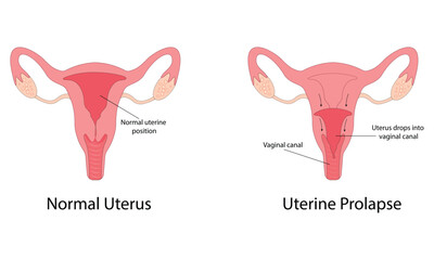 Uterine prolapse vector illustration