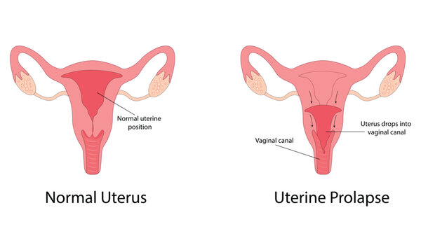 Uterine prolapse vector illustration