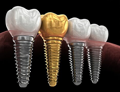 Dental implants, including one gold crown, shown in close-up