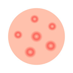 Acne facial type concept. vector illustration