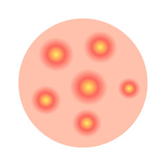 Acne facial type concept. vector illustration