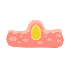 Acne facial type concept. vector illustration