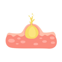 Acne facial type concept. vector illustration