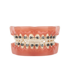 Dental model showing braces on teeth for orthodontic education  