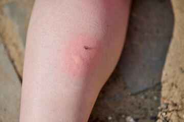 Red, swollen mosquito bite visible on leg during daylight. Outdoor setting with rough ground background. Shot captures discomfort and irritation from side angle