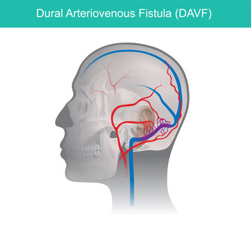 Dural Arteriovenous Fistula (DAVF).