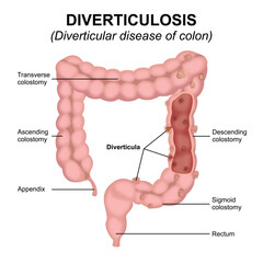 Diverticulosis - Diverticular disease of colon