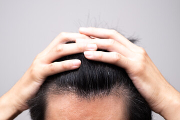 薄毛を気にする男性（M字に後退する額）