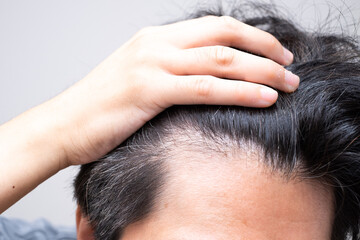 Fototapeta premium 薄毛を気にする男性（M字に後退する額）