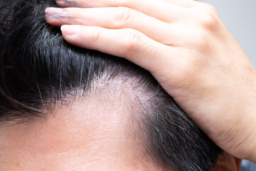 薄毛を気にする男性（M字に後退する額）