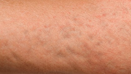 Fototapeta premium close-up textured skin with stretch marks showing fine lines and subtle irregularities in smooth tone ideal for skin care or dermatology illustration