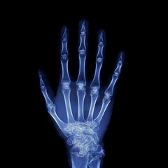 x-ray overlay of a human hand showing bones, joints, and skeletal structure on dark background