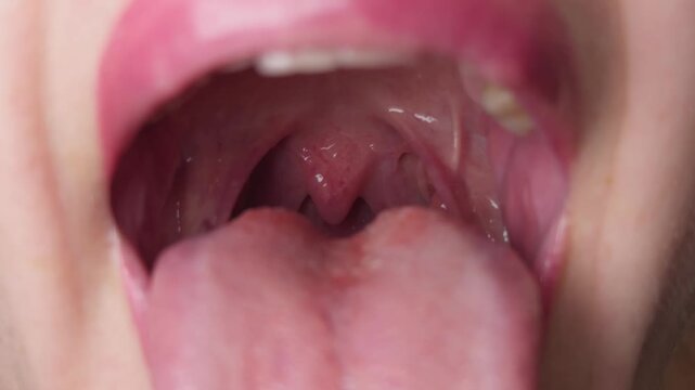 Close-up of an open mouth of a woman with an inflamed throat, tonsils, and tongue