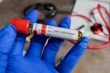 Lupus erythematosus vaccination drug in blue gloved hands. Medical concept