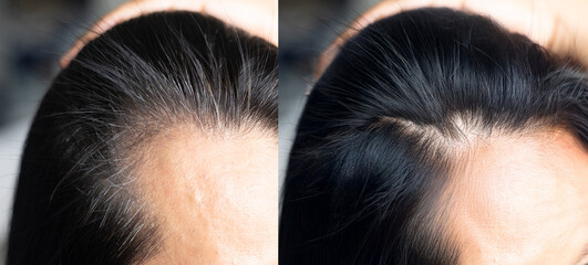 Woman before and after hair loss treatment on white background

