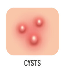 Cysts vector illustration. Acne type. Vector 3d clipart