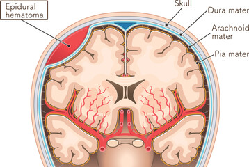 硬膜外血腫のイラストIllustration of an epidural hematoma