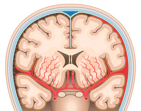 くも膜下出血のイラスト Illustration of subarachnoid hemorrhage