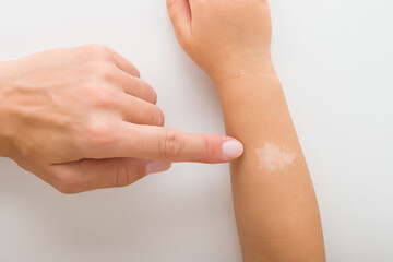 Young adult mother finger pointing to white fresh healed baby skin after allergy treatment. White spot on tanned arm. Isolated on light gray table background. Closeup. Top down view.