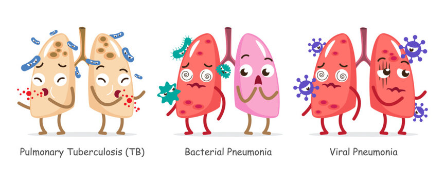 Set of lung infection disease cartoon characters . Including pulmonary tuberculosis, bacterial pneumonia and viral pneumonia . Isolated on white background . Vector .