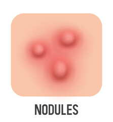 Nodules vector illustration. Acne type. Vector 3d clipart