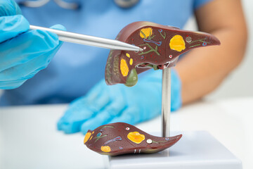 Cirrhosis, Liver cancer, fatty liver, Asian doctor with liver human anatomy model in World Hepatitis Day at hospital.