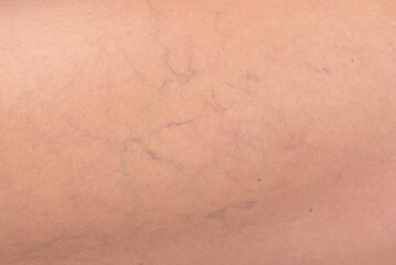 Macro photo showing varicose veins and capillaries on a woman’s skin. Close-up detail of vascular issues for dermatology, medicine, and aging body care concepts.